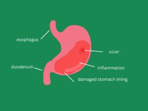 Gastritis Diagnosis and Treatment 