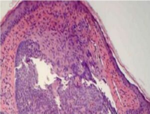 Basal Cell Carcinoma Identified under H&E Staining